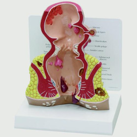 GPI Anatomicals rectum cross-section oversized model with pathologies