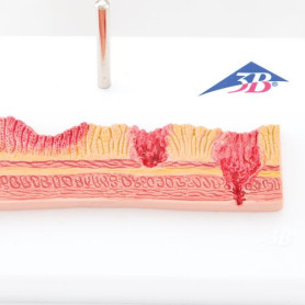 3B Scientific stomach section model with ulcers