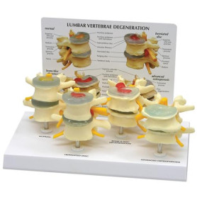 GPI Anatomicals 2- part lumbar vertebrae model set (4pcs)